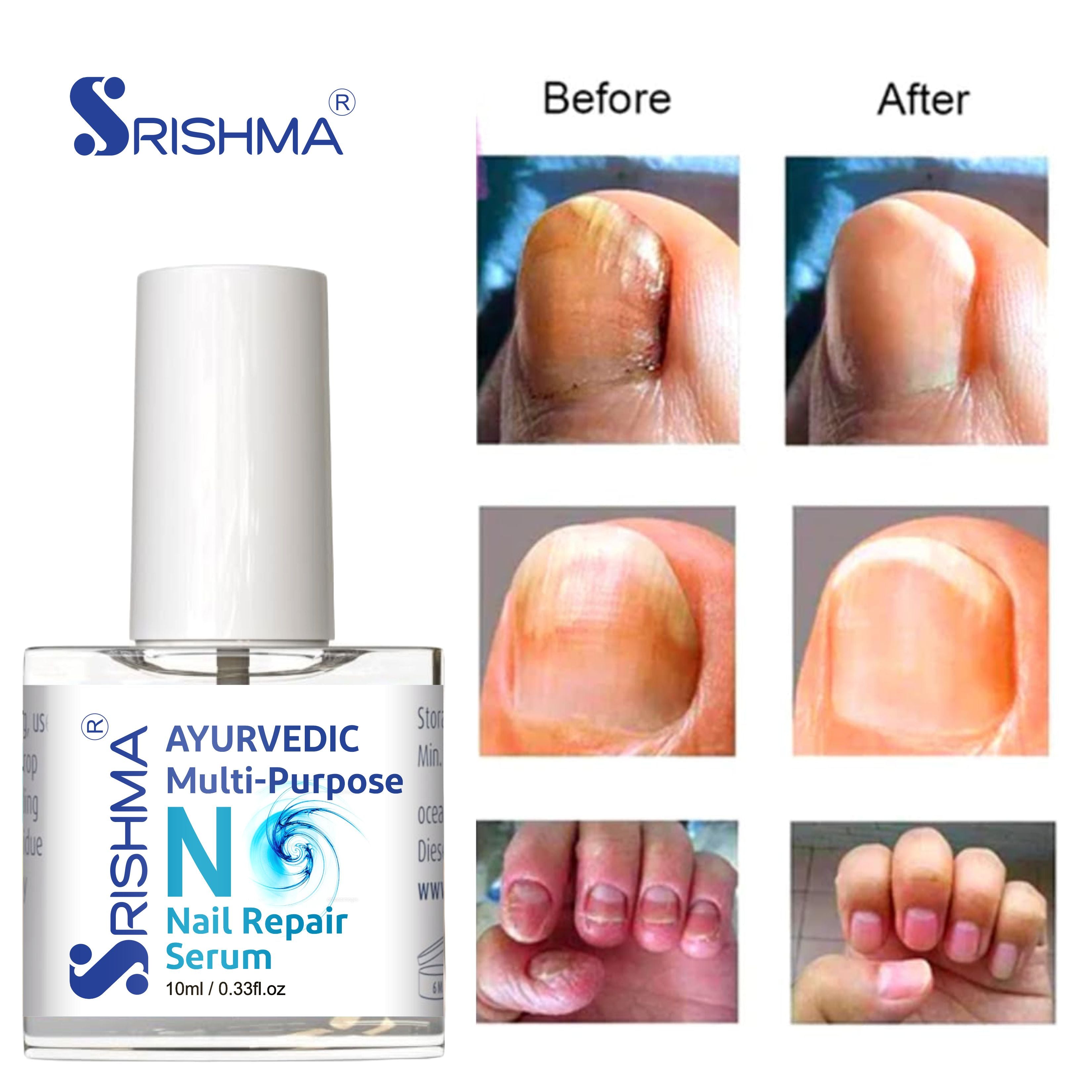 Nail Repair Serum for Stimulates Nail Growth, For Damaged Skin & Thin Nails